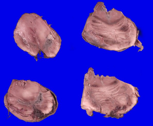 4A4 Autolysis (Respirator Brain) (Case 4)