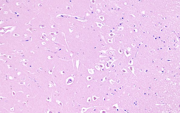 4B2 Autolysis (Respirator Brain) (Case 4) N1 H&E