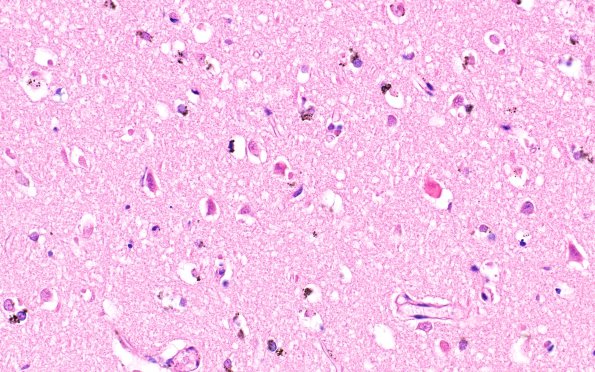 4B3 Autolysis (Respirator Brain) (Case 4) N1 H&E 40X