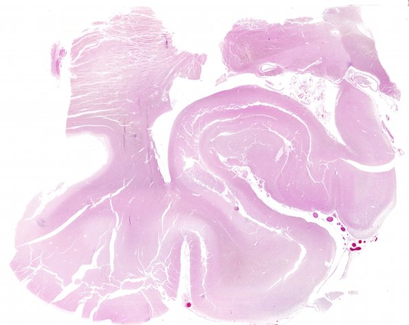 4B4 Autolysis (Respirator Brain) (Case 4) N3 H&E