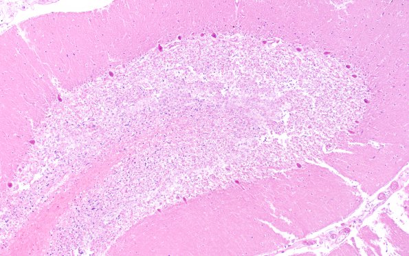 4B6 Autolysis (Respirator Brain) (Case 4) N9 H&E