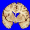 10A1 Infarct,H-I, sickle cell trait (Case 10) 7 copy