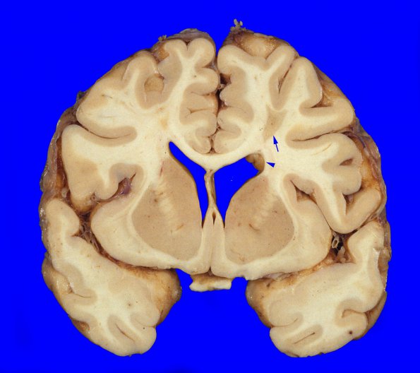 10A1 Infarct,H-I, sickle cell trait (Case 10) 7 copy