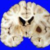 10A2 Infarct & Hypoxia Ischemia, sickle cell trait (Case 10) c