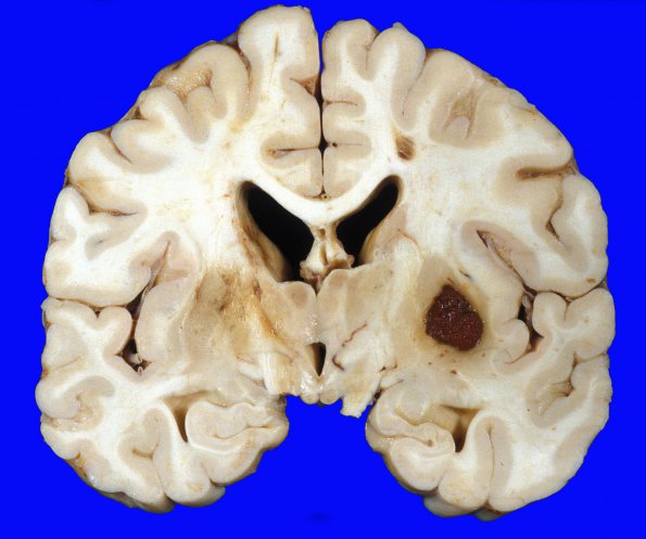 10A2 Infarct & Hypoxia Ischemia, sickle cell trait (Case 10) c