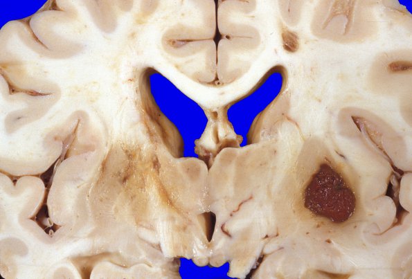 10A3 Infarct & Hemorrhage, SCTrait (Case 10) b