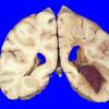 10A4 Infarct,Hemorrhage, SCTrait (Case 10) 2 copy