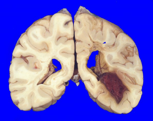 10A4 Infarct,Hemorrhage, SCTrait (Case 10) 2 copy