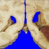 10A5 Infarcts & hemorrhage,SCTrait A (Case 10) 5