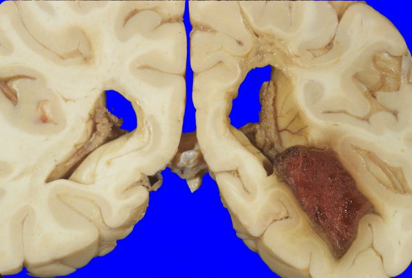 10A5 Infarcts & hemorrhage,SCTrait A (Case 10) 5