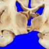 10A6 Infarct,H-I, sickle cell trait (Case 10) 3 copy