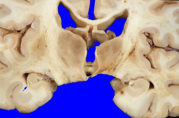 10A6 Infarct,H-I, sickle cell trait (Case 10) 3 copy