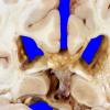 10A8 Infarct & Hypoxia Ischemia, sickle cell trait (Case 10) a