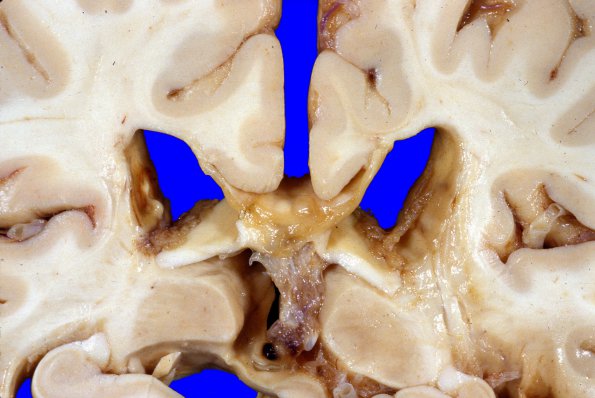 10A8 Infarct & Hypoxia Ischemia, sickle cell trait (Case 10) a