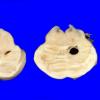 10A9 Infarct,H-I, sickle cell trait (Case 10) 8