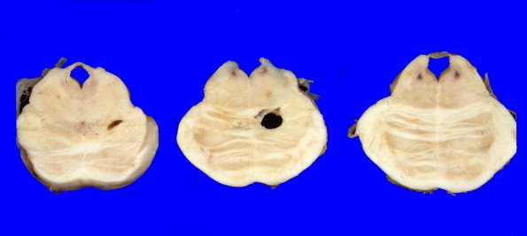 10A9 Infarct,H-I, sickle cell trait (Case 10) 8