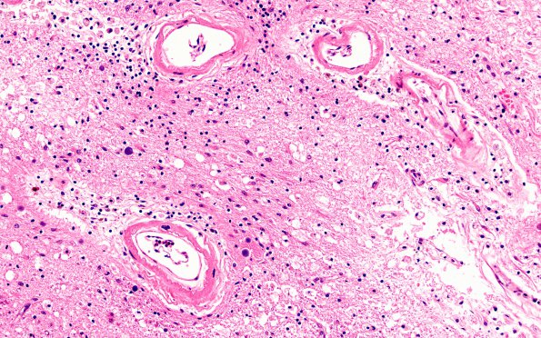 10B10 Infarct,H-I, sickle cell trait (Case 10) N17 20X