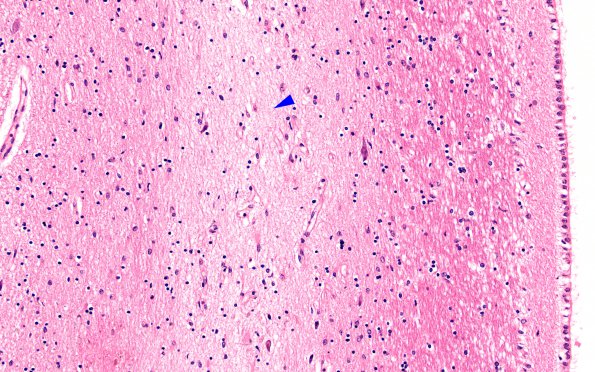 10B12 Infarct,H-I, sickle cell trait (Case 10) N3 CA1 20X copy