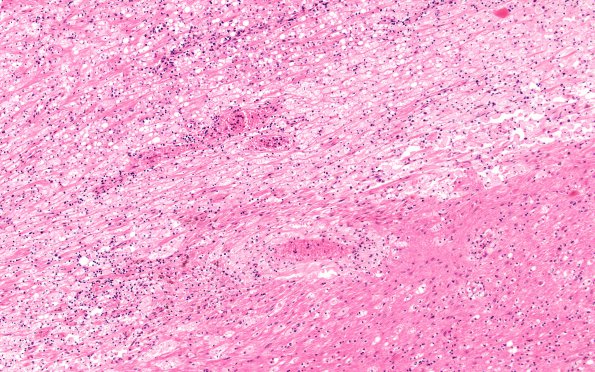 10B13 Infarct,H-I, sickle cell trait (Case 10) N11 10X