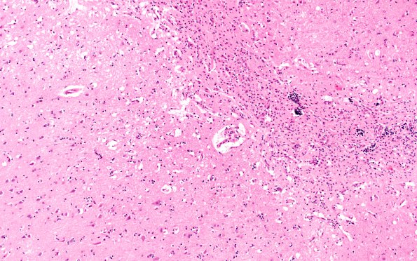 10B14 Infarct,H-I, sickle cell trait (Case 10) N16 10X