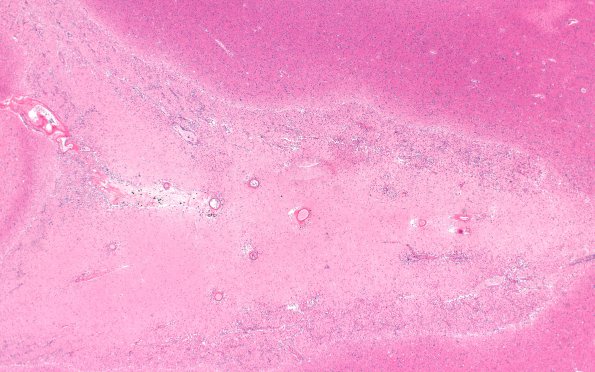 10B2 Infarct,H-I, sickle cell trait (Case 10) N1 2X