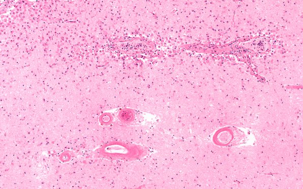 10B3 Infarct,H-I, sickle cell trait (Case 10) N1 10X