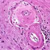 10B4 Arteriolosclerosis (Case 10) H&E 1