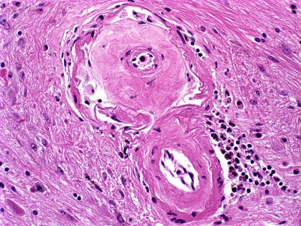 10B4 Arteriolosclerosis (Case 10) H&E 1