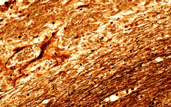 10B6 Infarct,H-I, sickle cell trait (Case 10) N1 Biels 40X