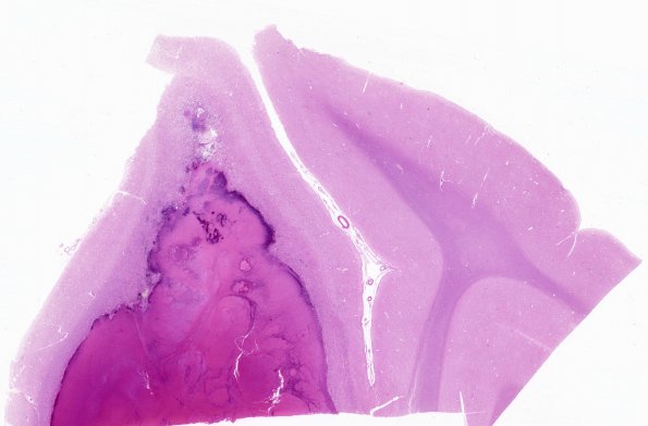 10B7 Hemorrhage, SCTrait (Case 10) N5D WM2