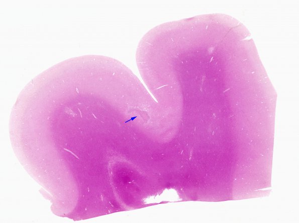 10B8 Infarct,H-I, sickle cell trait (Case 10) N16 WM copy