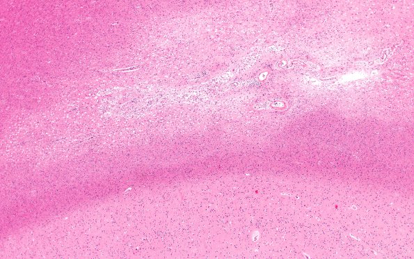 10B9 Infarct,H-I, sickle cell trait (Case 10) N17 4X