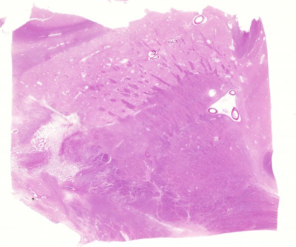 10C1 Infarct,H-I, sickle cell trait (Case 10) N2B H&E WM