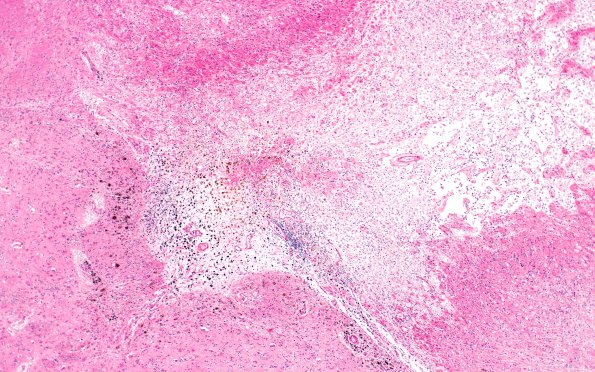 10C2 Infarct,H-I, sickle cell trait (Case 10) N2B 4X