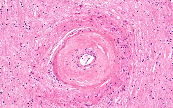 10C3 Infarct,H-I, sickle cell trait (Case 10) N2B 20X