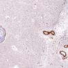 10C4 Infarct,H-I, sickle cell trait (Case 10) N2B SMA 4X