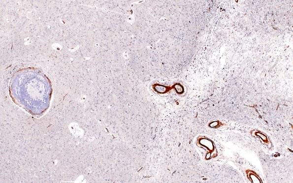 10C4 Infarct,H-I, sickle cell trait (Case 10) N2B SMA 4X