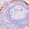 10C5 Infarct,H-I, sickle cell trait (Case 10) N2B SMA 20X