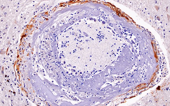 10C5 Infarct,H-I, sickle cell trait (Case 10) N2B SMA 20X