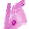 10D1 Hemorrhage, Infarct,H-I, sickle cell trait (Case 10) N4 WM2