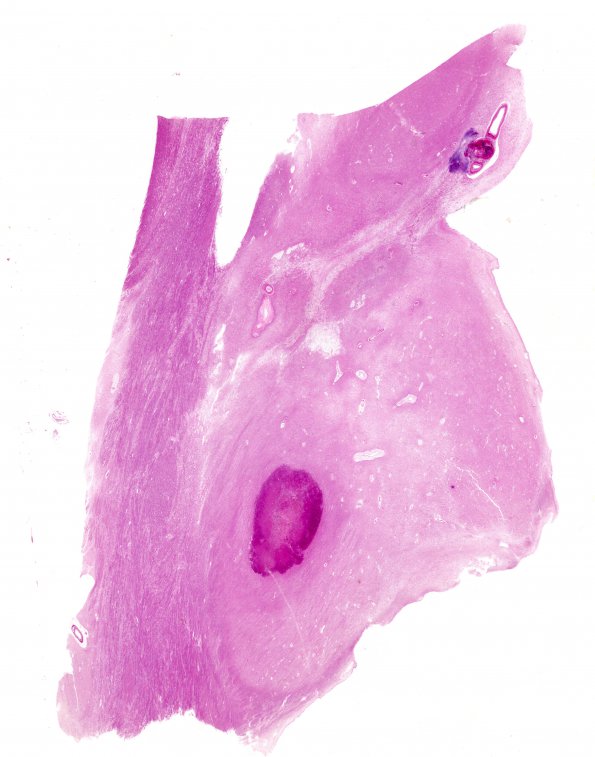 10D1 Hemorrhage, Infarct,H-I, sickle cell trait (Case 10) N4 WM2