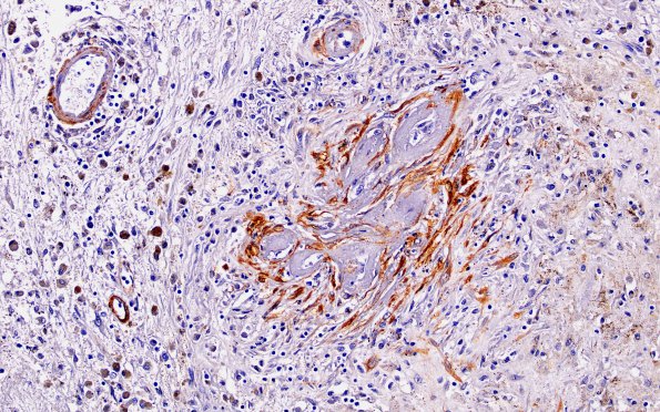 10D6 Infarct,H-I, sickle cell trait (Case 10) N4 SMA 10X