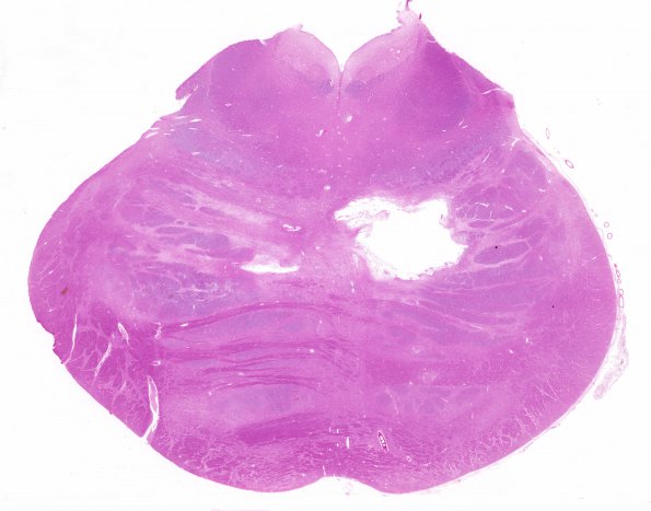 10E1 Infarct,H-I, sickle cell trait (Case 10) N7 WM