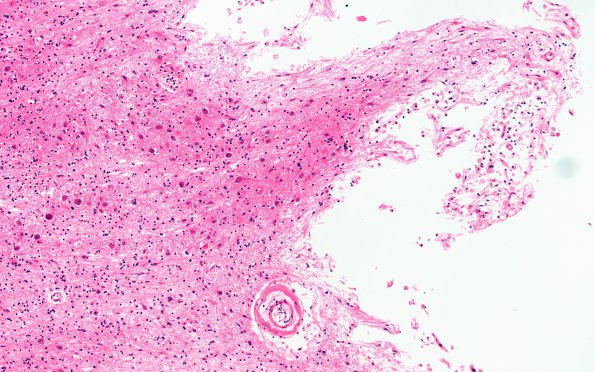 10E2 Infarct,H-I, sickle cell trait (Case 10) N7 10X