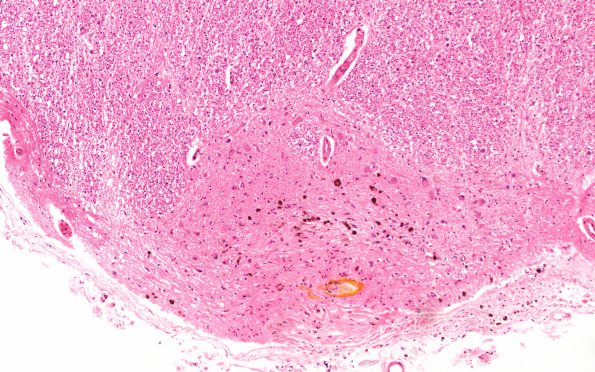 10E3 Infarct,H-I, sickle cell trait (Case 10) N8 20X