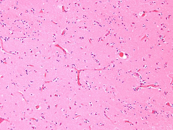 11A1 Sickle Cell Anemia, hypoxia-ischemia, (N2, Case 11) H&E 1