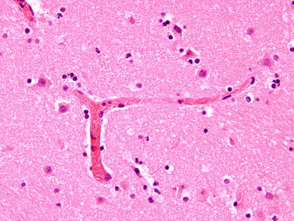 11A2 Sickle Cell Anemia, hypoxia-ischemia, (N2, Case 11) H&E 4