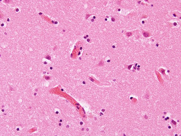 11A3 Sickle Cell Anemia, hypoxia-ischemia, (N2, Case 11) H&E 5