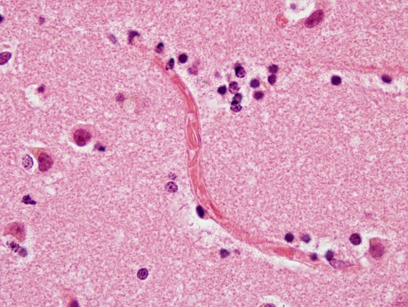 11A4 Sickle Cell Anemia, hypoxia-ischemia, (N2, Case 11) H&E 7