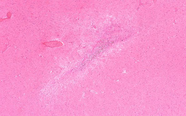 11A5 Sickle Cell Anemia, hypoxia-ischemia, (Case 11) N4 4X